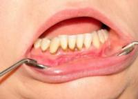 پاپیل های بین دندانی و مشکلات آنها