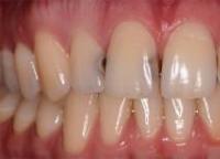 Primarna prevencija zubnog karijesa