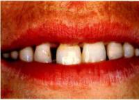 Gingivitis (upala zubnog mesa) - vrste i oblici (kataralni, hipertrofični, ulcerativni, nekrotični, akutni i kronični), uzroci bolesti, simptomi (zadah iz usta, bol, krvarenje i dr.)