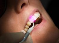 โรคปริทันต์: วิธีรักษาฟันและยาอะไรที่ช่วยได้