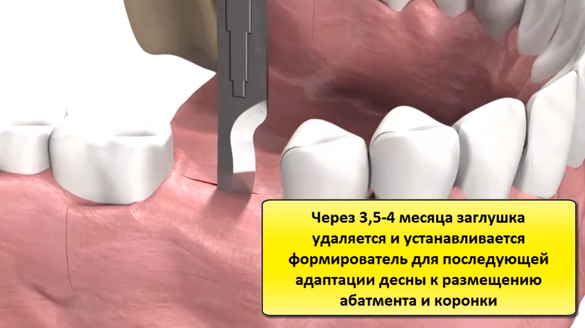 Коронка после удаления зуба. Имплант формирователь коронка. Коронка абатмент формирователь. Формирователь десневой манжеты. Формирователь коронки на импланты.